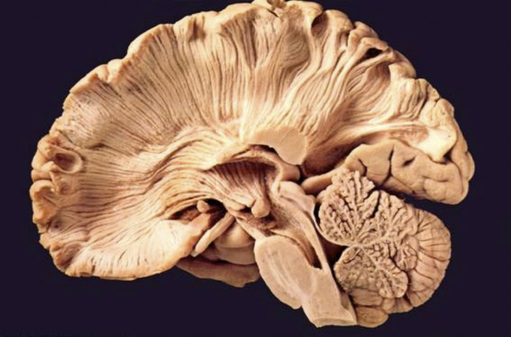 Axonal Tracts in Human Brain