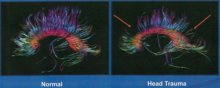 DTI - Diffusion Tensor Imaging MRI for Abnormal Axonal Tracts