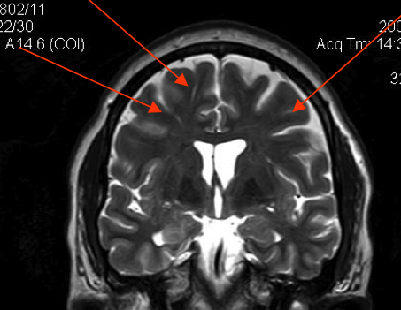 Dilated Perivascular Spaces show diffuse axonal injury.