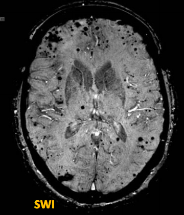 SWI shows abnormalities in brain.