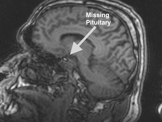 Pituitary gland damaged by trauma
